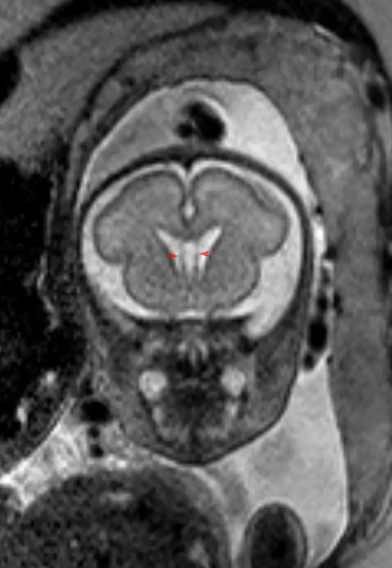 Grayscale prenatal MRI slice showing a cross-section of a fetal head and brain inside the uterus